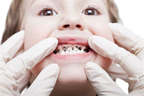 niños con dientes podridos - glucosamina con condroitina